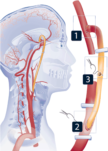 Image: Schematic representation of the ELANA technique (photo courtesy of Elana).